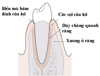 VIÊM QUANH RĂNG MẠN TÍNH