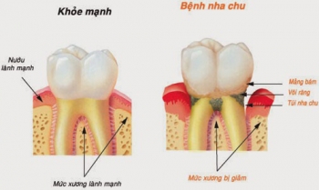 Viêm nha chu ảnh hưởng lớn tới sức khoẻ